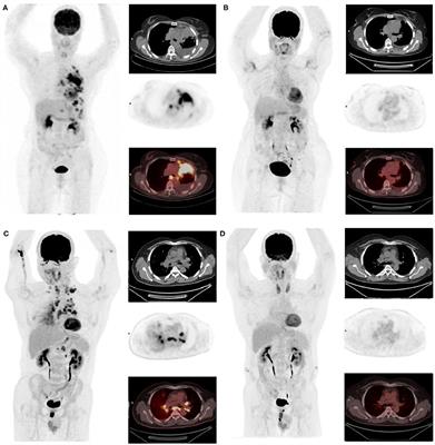 Case Report: Two Rare Cases of Complete Metabolic Response to Crizotinib in Patients With Rearranged ROS1 and ALK Metastatic Non-small Lung Cancer